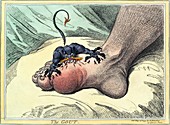 Gout,18th-century caricature