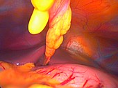 Healthy abdomen,laparoscopic view