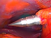 Keyhole surgery,laparoscopic view