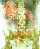 Full-term foetus,X-ray