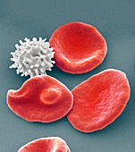 Healthy and crenated red blood cells,SEM