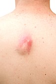 Abscess on the back