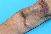 AV fistula in the arm for renal dialysis