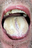Thrush (candidiasis) of the tongue