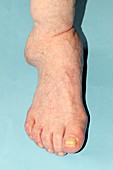 Arthritic ankle in Charcot's disease