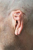 Deformed pinna of the ear
