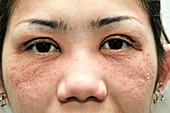 Face dermatitis due to cosmetic allergy