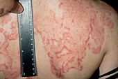 Psoriasis on the back before treatment