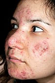 Acne vulgaris on the face in a girl