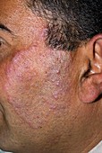 Tinea fungal infection on the face