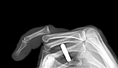 Dislocated finger,X-ray
