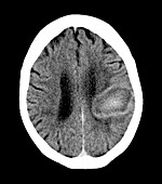 Haematoma,CT scan