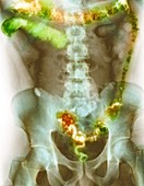 Ulcerative colitis,X-ray
