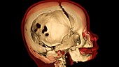 Child's skull,3D CT scan