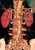 Calcified aortic artery,3D CT scan