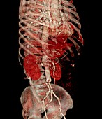 Aortic aneurysm CT scan