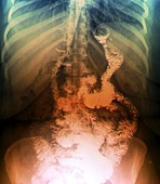 Gastric bypass surgery,X-ray