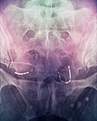 Incontinence implant,X-ray