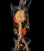 Aortic aneurysm CT scan