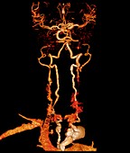Takayasu's arteritis,3d CT scan