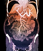 Chronic liver disease,CT scan