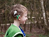 Bilateral cochlear implants