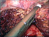 Secondary liver cancer surgery