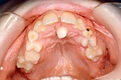Ectopic dental eruption