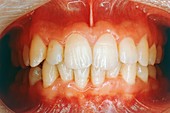 Treated gum inflammation