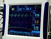 Thoracic Impedance Monitor