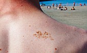 Skin pigmentation after sunburn