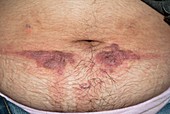 Contact dermatitis from a belt buckle