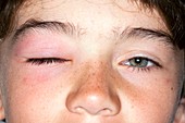 Allergy causing a swollen eye