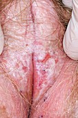 Lichen sclerosis around the anus