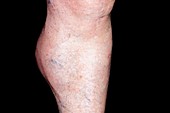 Baker's cyst on the leg