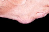 Bursitis of the fifth toe