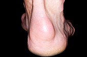 Bursitis of the heel of the foot
