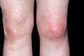 Gout of the knee joint