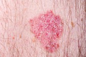 Basal cell skin cancer spread