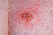 Herpes simplex lesion on the skin