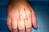 Knuckle joint replacement surgery