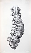 1852 Gideon Mantell's fused Spine