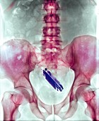 Mobile phone in a person's rectum,X-ray
