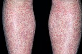 Allergic purpura on the legs