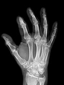 Osteoarthritis of the fingers,X-ray