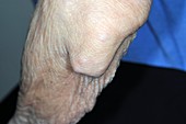 Rheumatoid arthritis of the elbow
