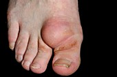 Ganglion on the dorsum of the toe