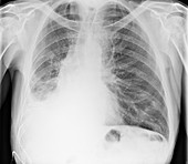Lung cancer with pleural effusion,X-ray