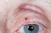 Basal cell skin cancer on the eyelid