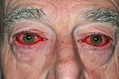 Adenoviral conjunctivitis of the eyes